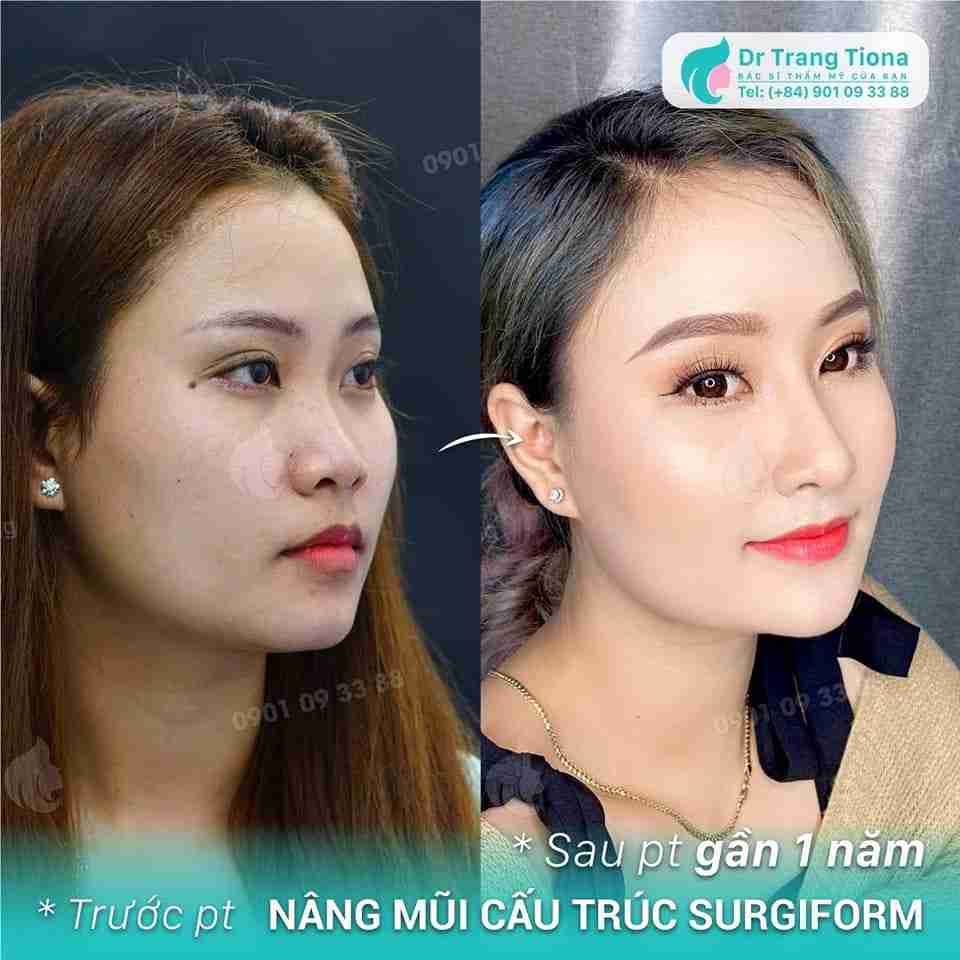 Nâng mũi cấu trúc duy trì hiệu quả bao lâu? 20 năm? 30 năm?