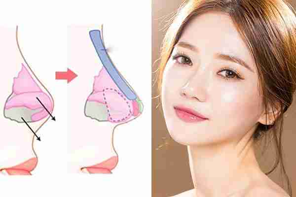 Nâng mũi cấu trúc là gì? Liệu có tốt để bạn sửa mũi?