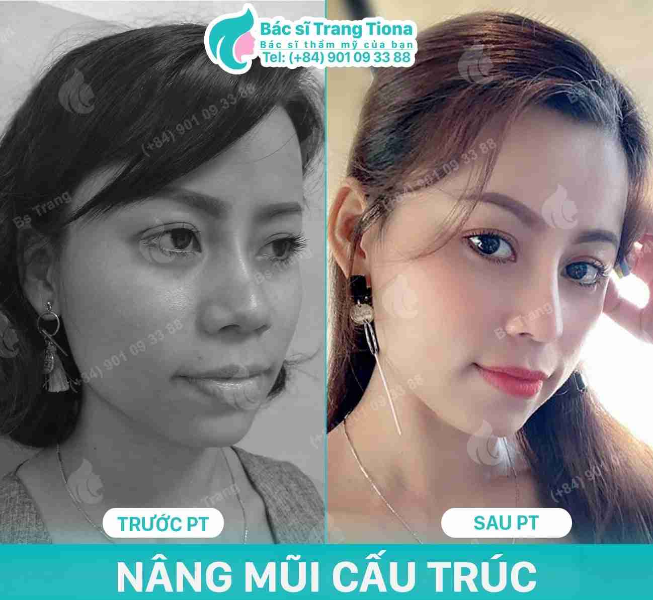 Nâng mũi cấu trúc là gì? Liệu có tốt để bạn sửa mũi?