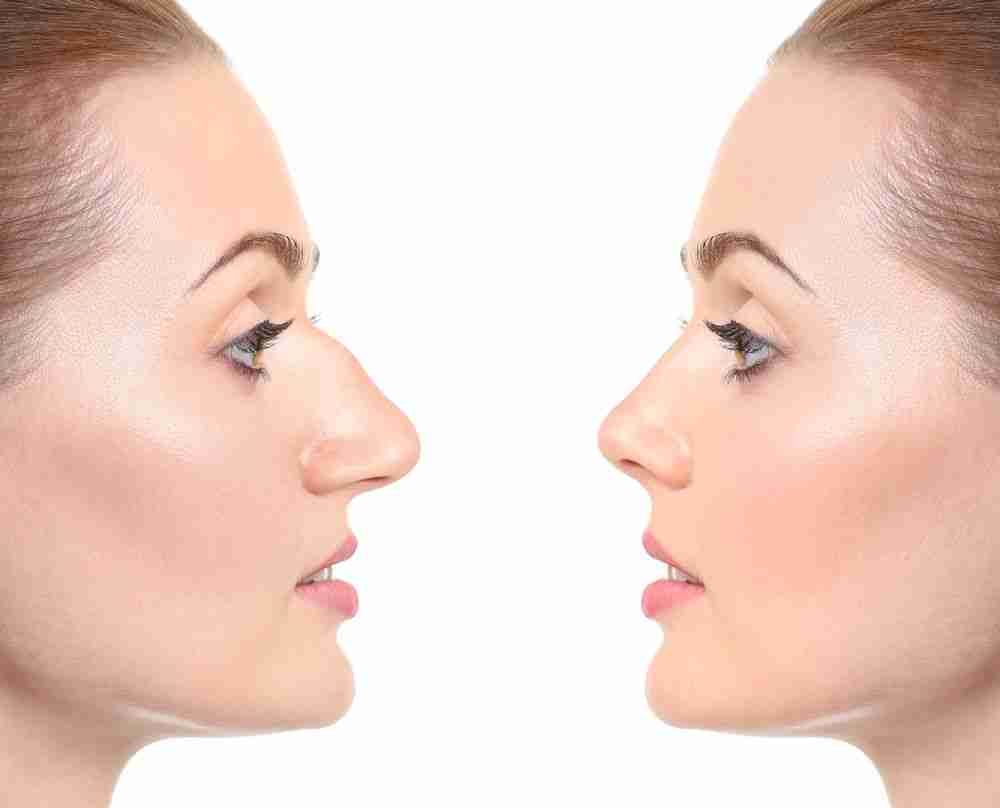 Bác sĩ giải đáp: Nâng mũi có cần mài xương mũi không?