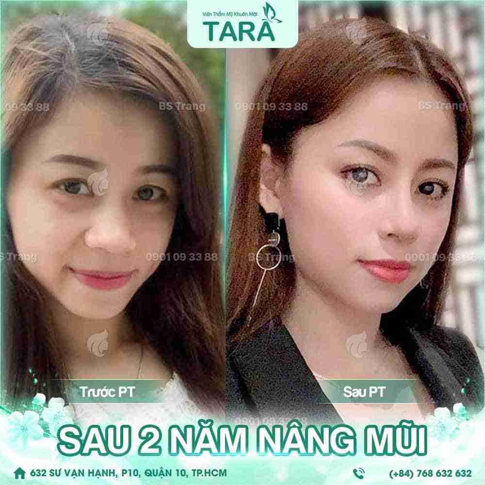 Nâng mũi có để lại di chứng phẫu thuật không? Cách phòng tránh?