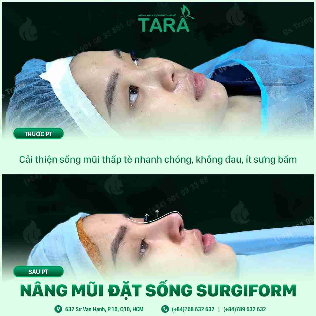 Bác sĩ giải đáp: Nâng mũi có hại về sau không?