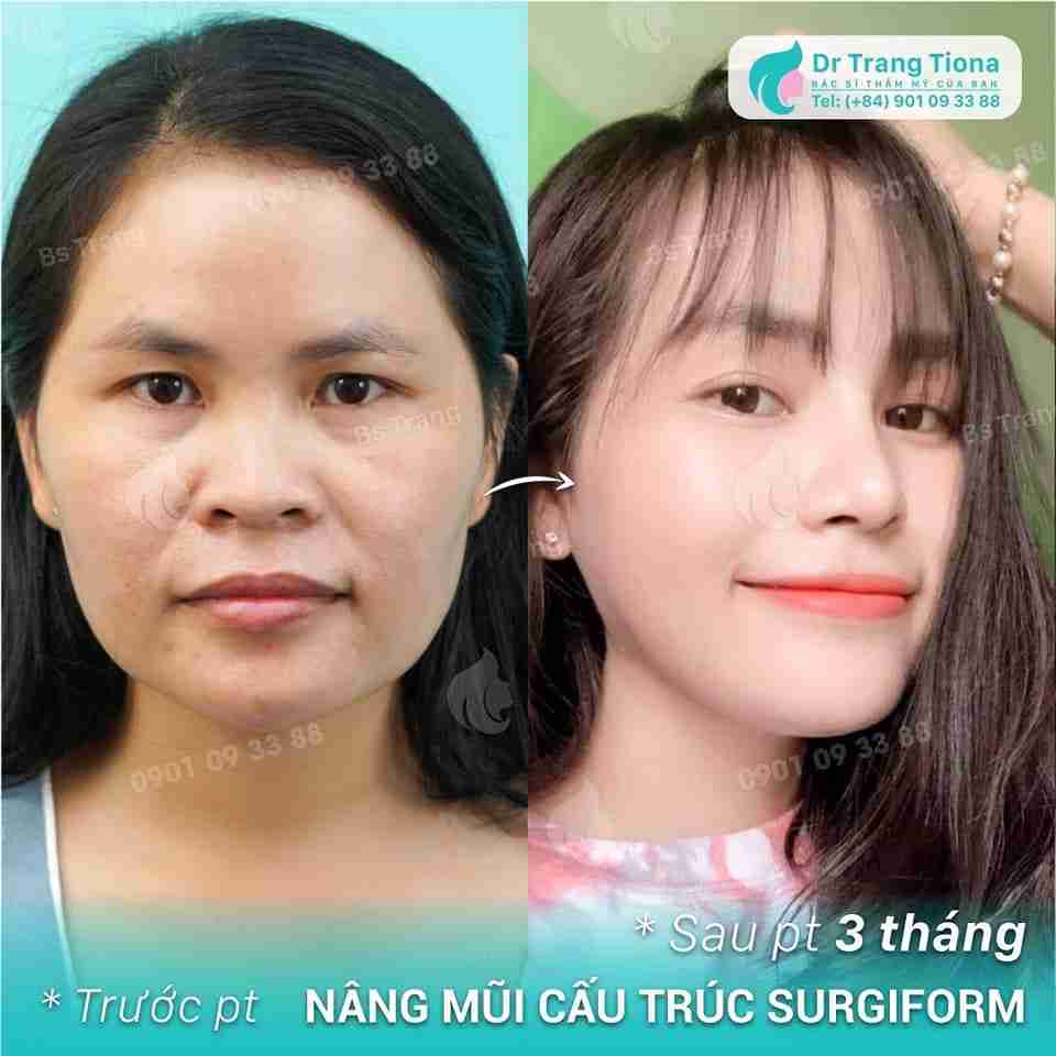 Nâng mũi có thay đổi khuôn mặt không?