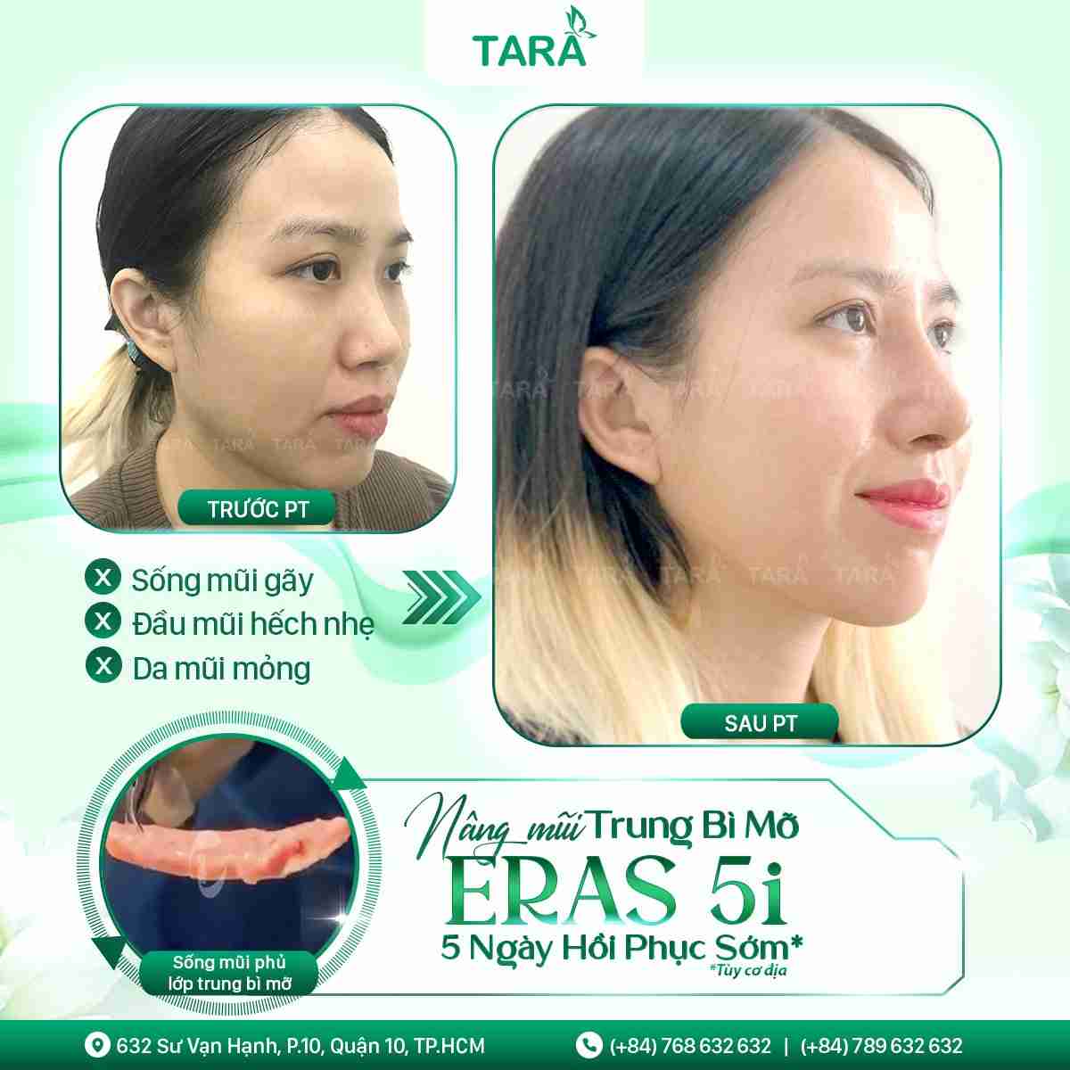 NÂNG MŨI ERAS 5i – 5 NGÀY PHỤC HỒI