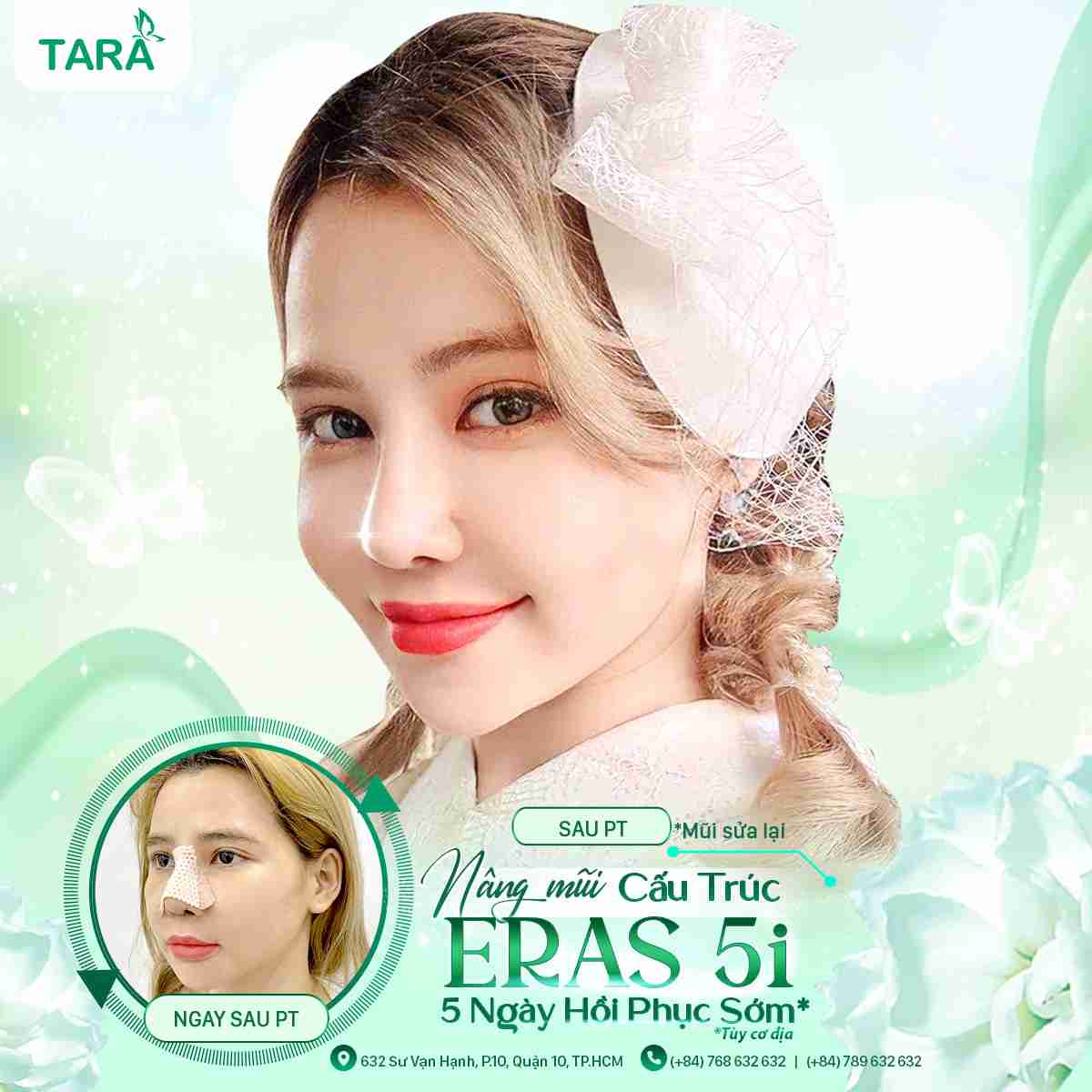 NÂNG MŨI ERAS 5i – 5 NGÀY PHỤC HỒI