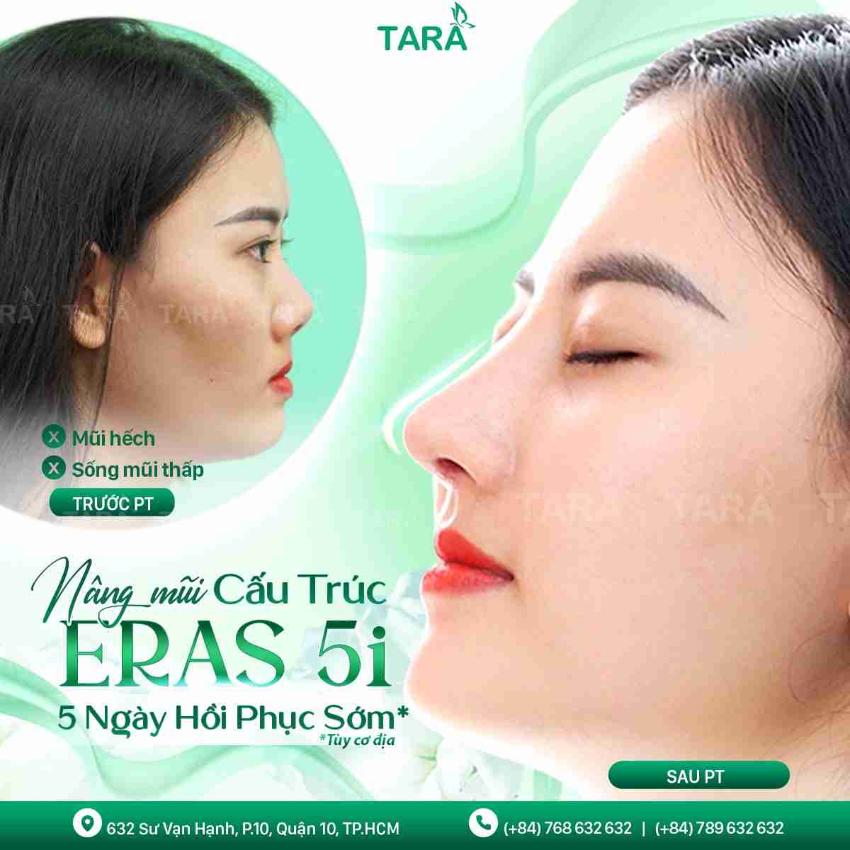 NÂNG MŨI ERAS 5i – 5 NGÀY PHỤC HỒI