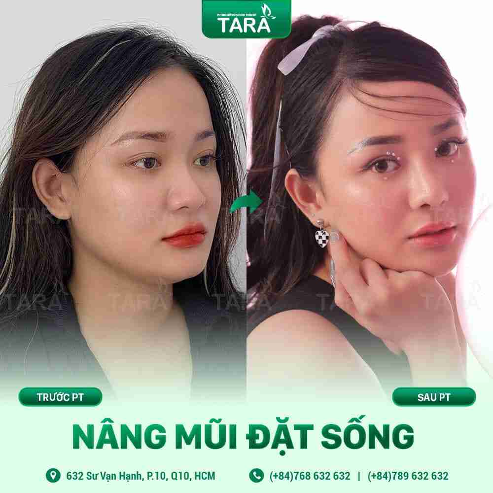 NÂNG MŨI ERAS 5i – 5 NGÀY PHỤC HỒI