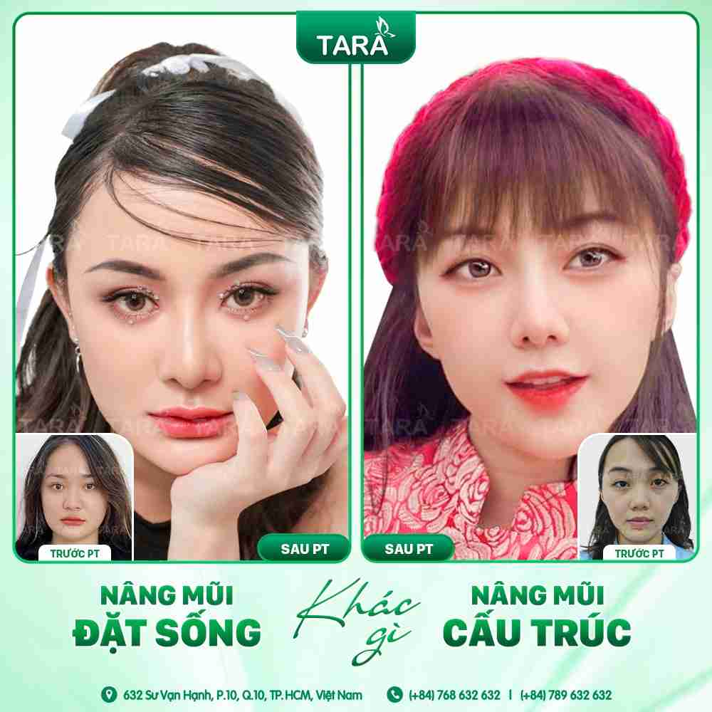 NÂNG MŨI ERAS 5i – 5 NGÀY PHỤC HỒI