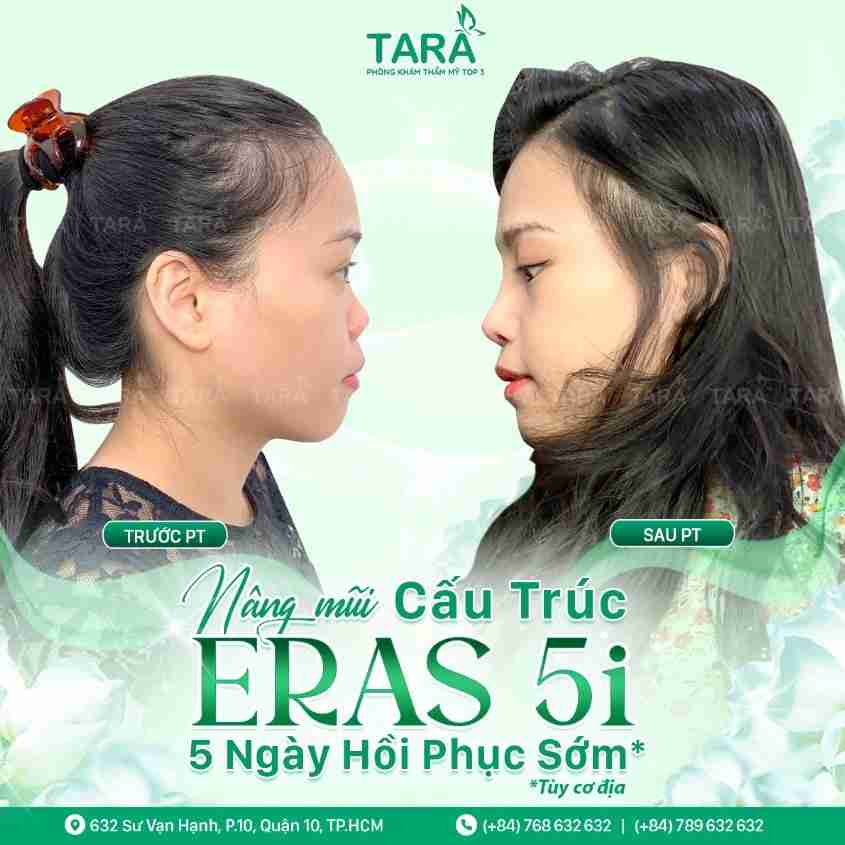 Nâng mũi ERAS 5i – Xu hướng nâng mũi 2024