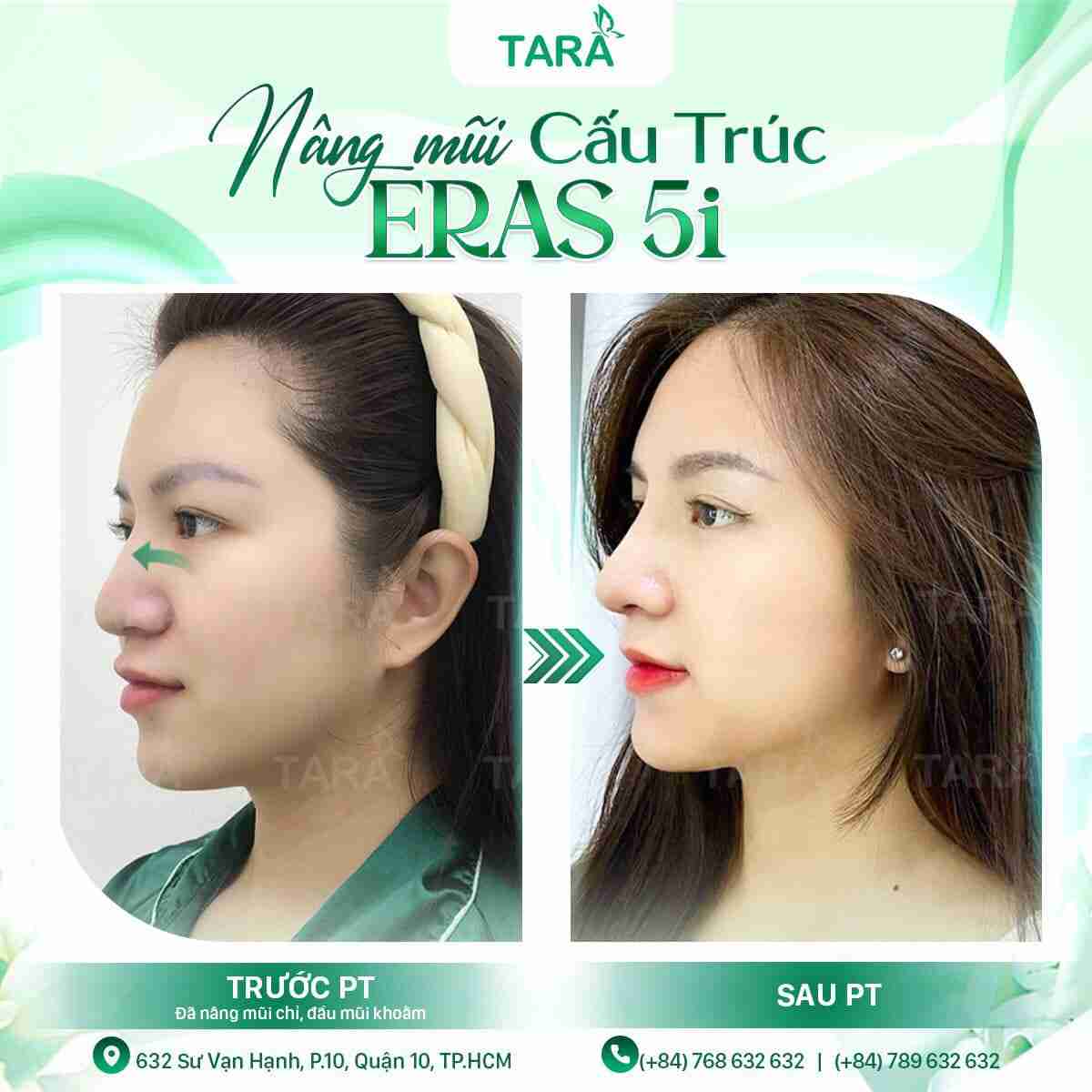 Nâng mũi ERAS 5i – Xu hướng nâng mũi 2024