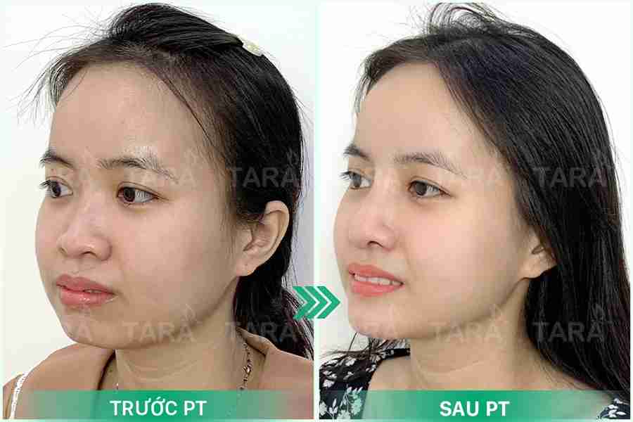 Nâng mũi hồi phục sớm 5 ngày – Nâng mũi ERAS 5i