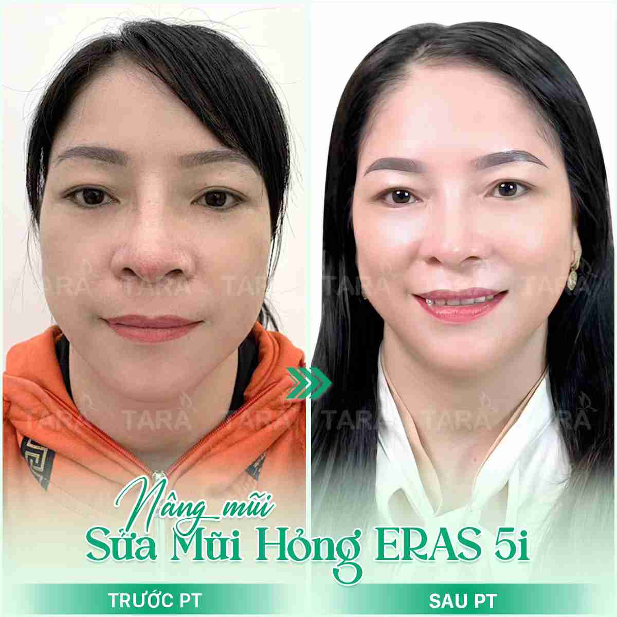 Nâng mũi hồi phục sớm 5 ngày – Nâng mũi ERAS 5i