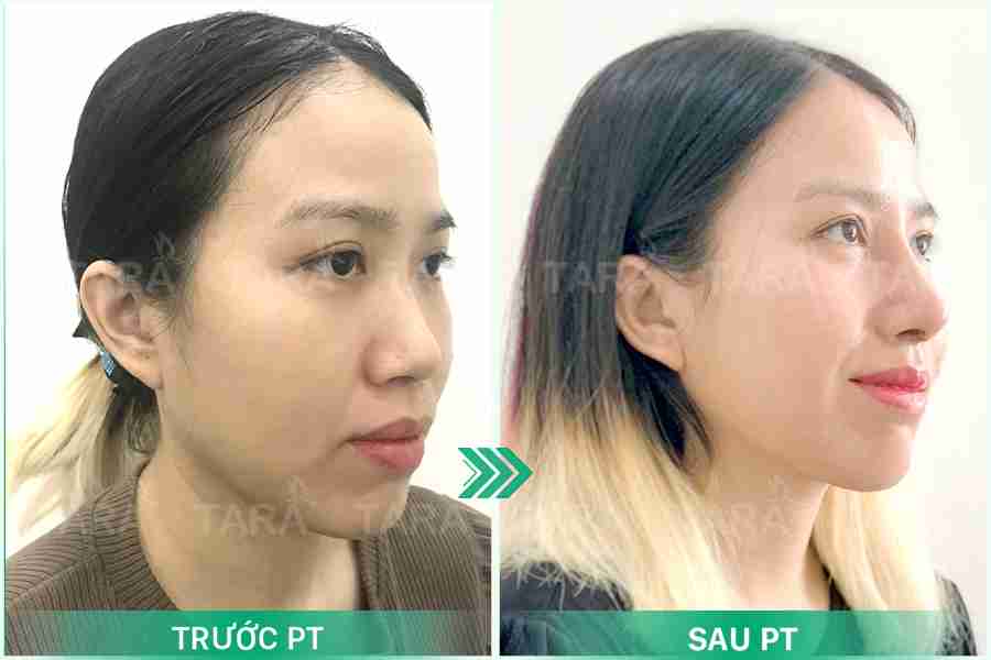 Nâng mũi hồi phục sớm 5 ngày – Nâng mũi ERAS 5i