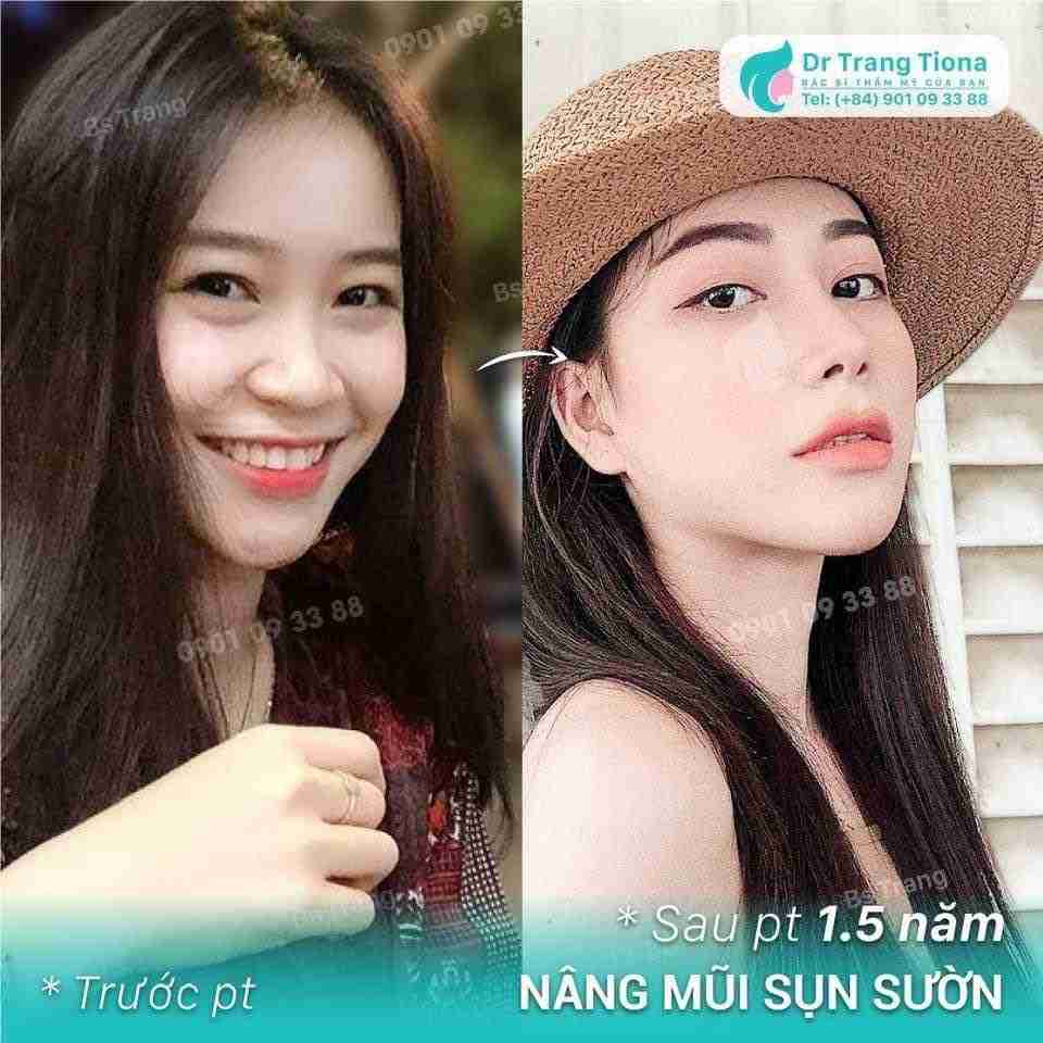 Nâng mũi giá bao nhiêu? Có đắt không?