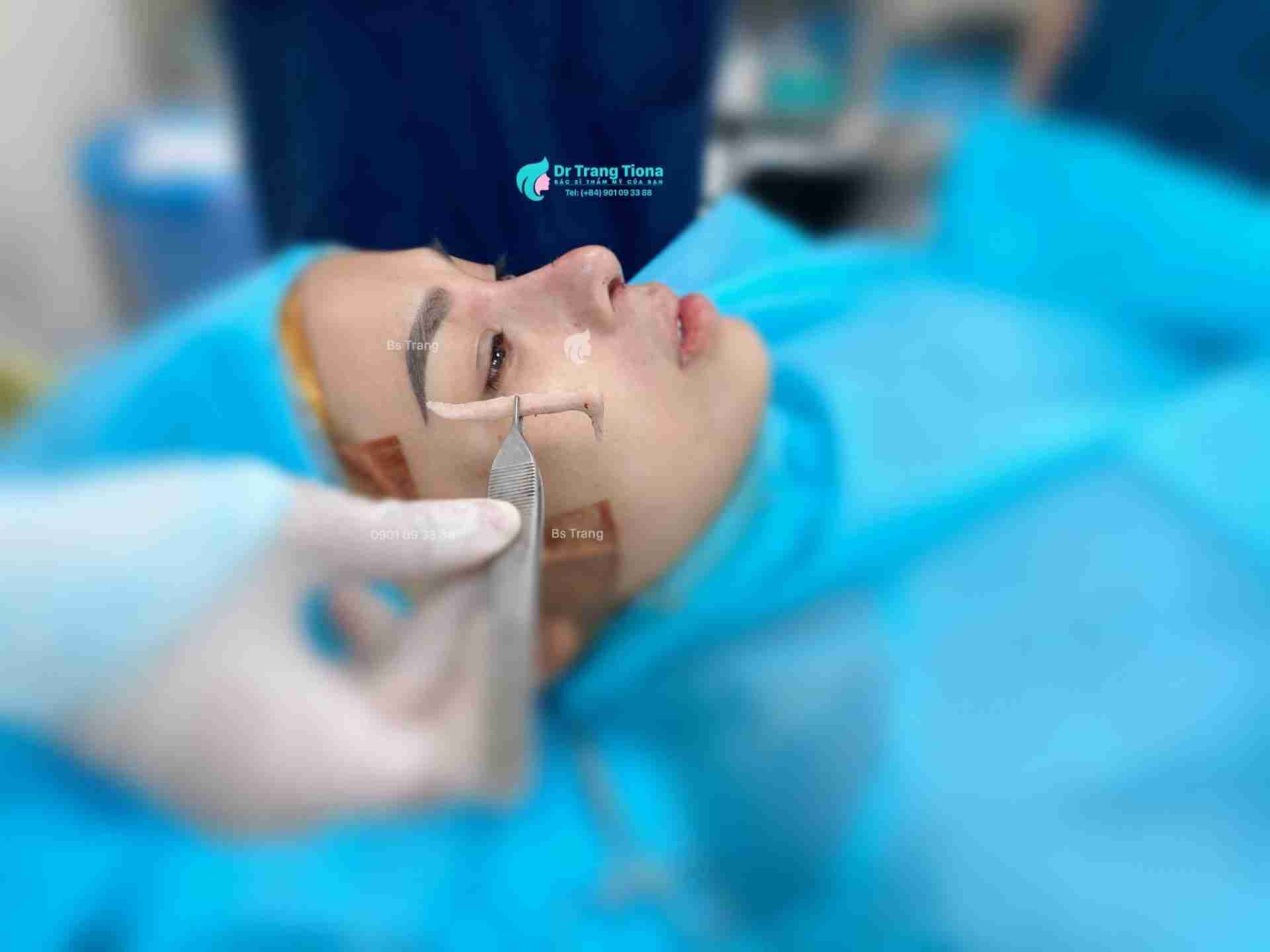 Nâng mũi giá bao nhiêu? Có đắt không?
