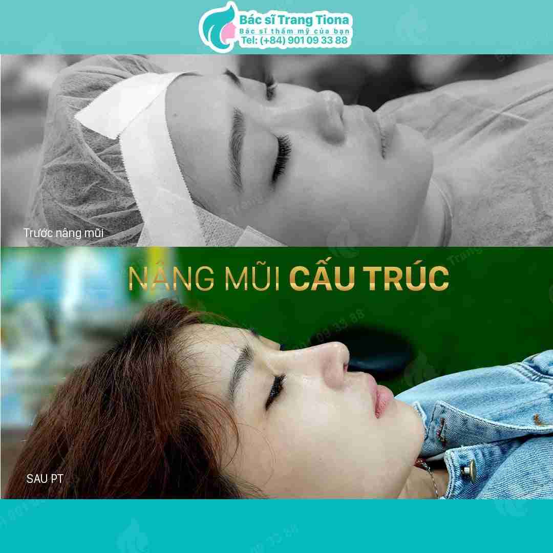 Nâng mũi không đau có thật không? Công nghệ nâng mũi không đau 4 trong 1 của Tara