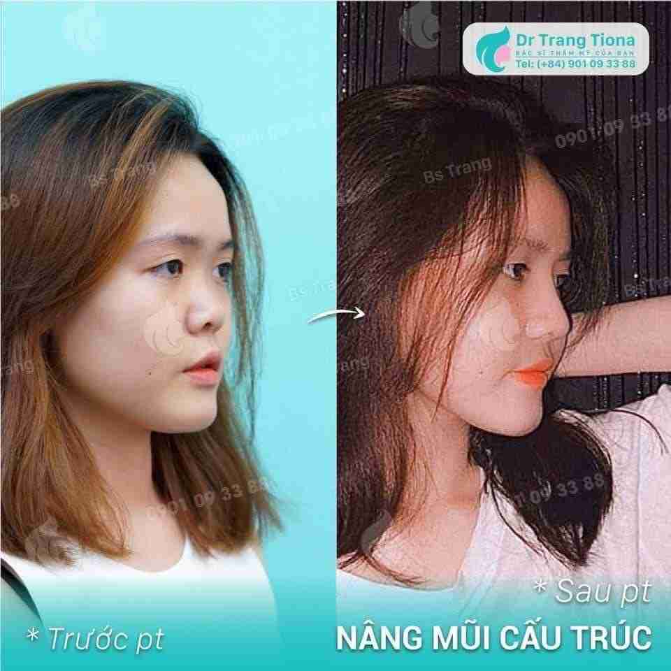 Nâng mũi không đau có thật không? Công nghệ nâng mũi không đau 4 trong 1 của Tara