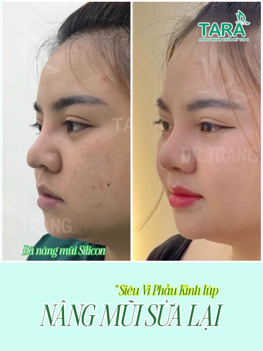 nâng mũi không nẹp lành thương nhanh