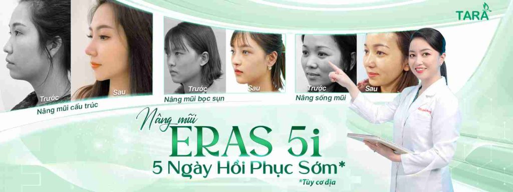 Nâng mũi mau lành – Phương pháp nâng mũi mau lành 5i