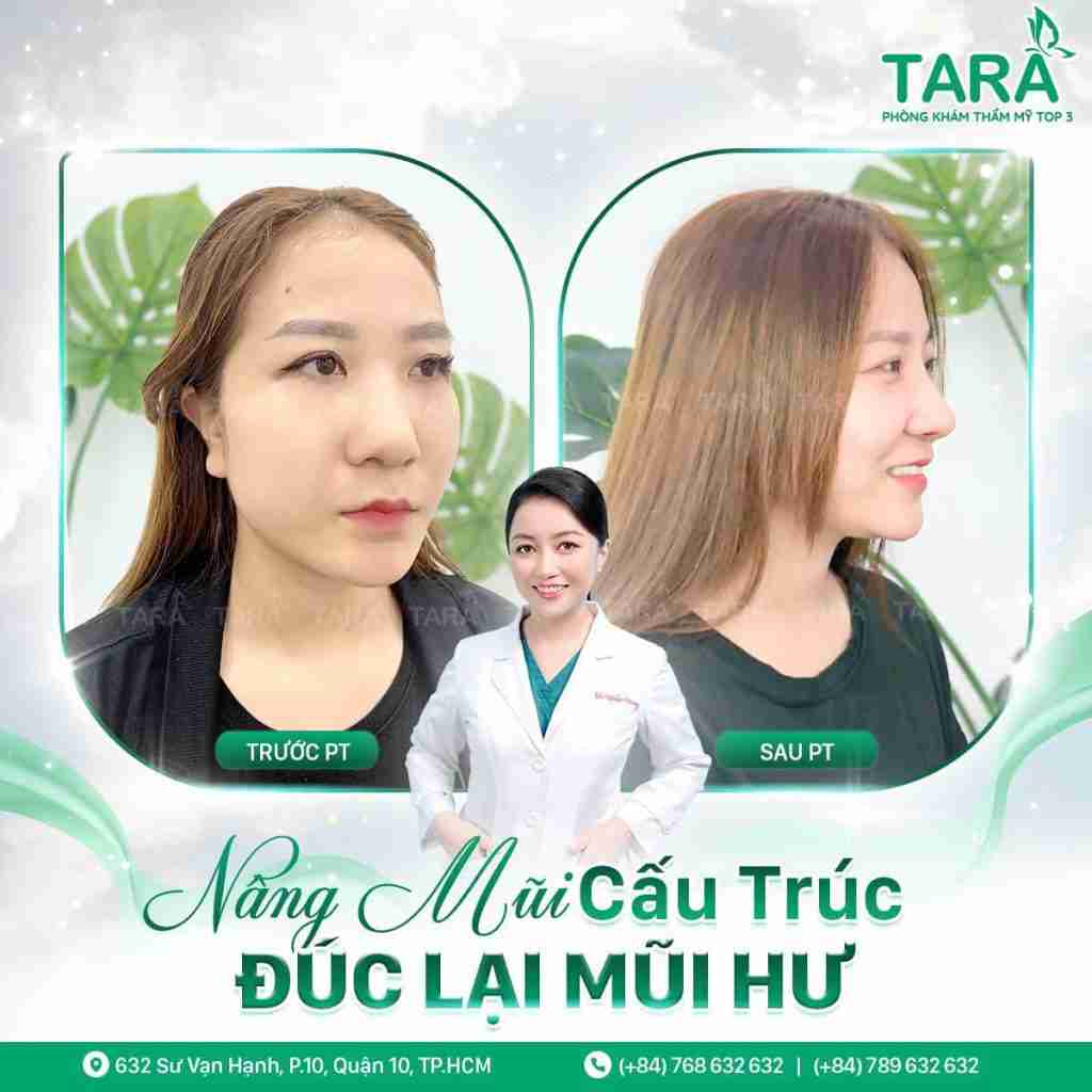 Nâng mũi mau lành – Phương pháp nâng mũi mau lành 5i