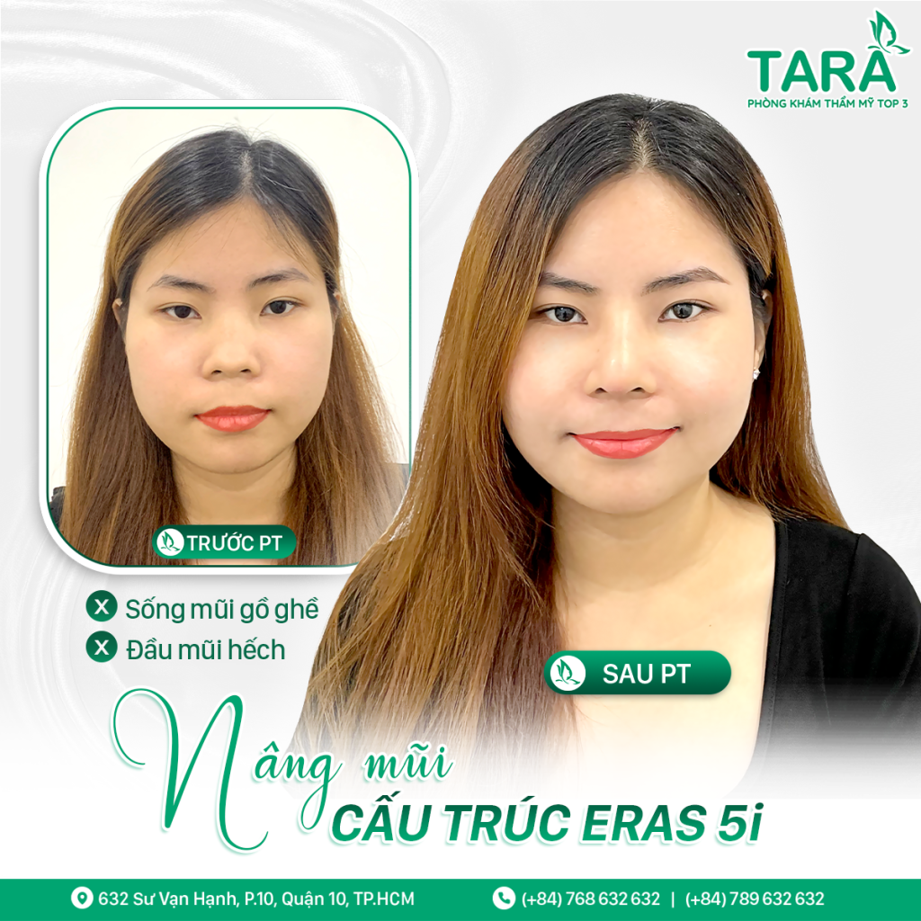 Nâng mũi mau lành – Phương pháp nâng mũi mau lành 5i