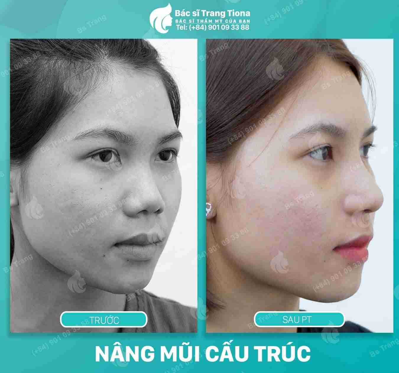 Nâng mũi ở đâu đẹp và an toàn? Làm sao để nhận biết?