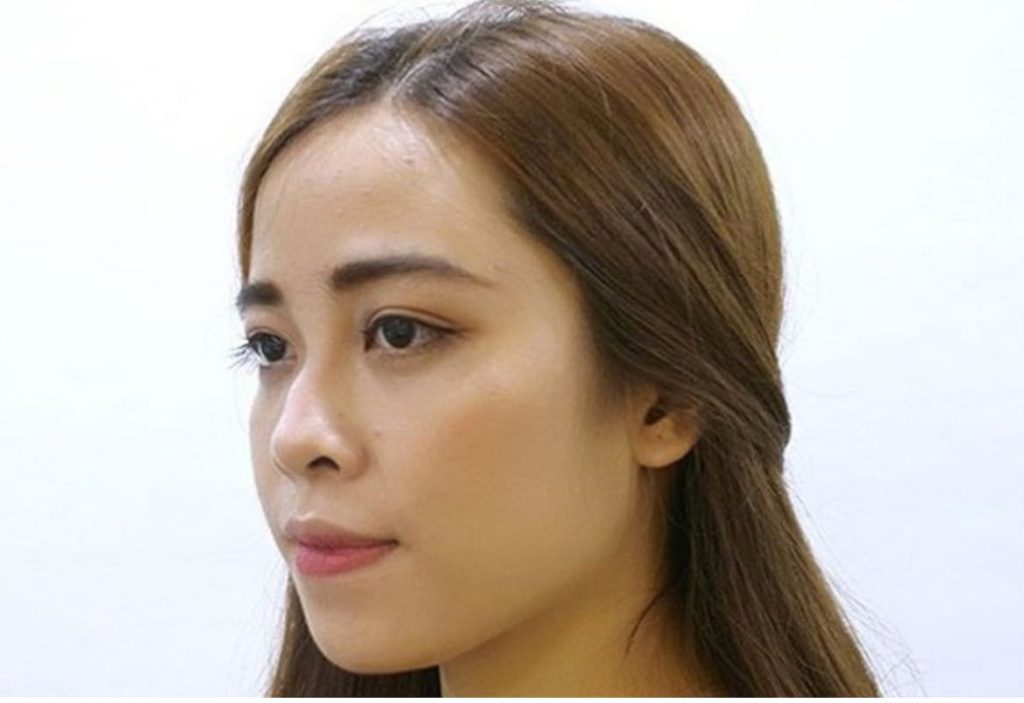 Giải pháp nâng mũi phù hợp cho người mũi gãy