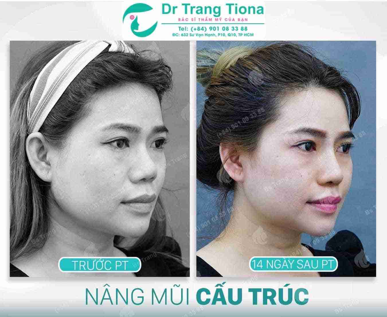 Giải đáp: Nâng mũi sau 2 tháng bị sưng có sao không?