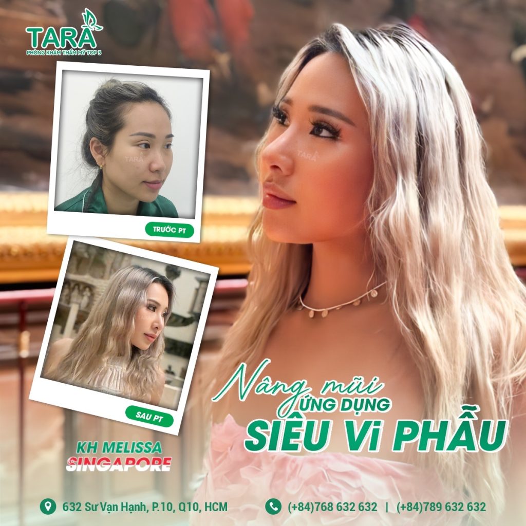 Nâng mũi siêu vi phẫu bằng sụn nhân tạo: Lựa chọn phù hợp cho từng dáng mũi