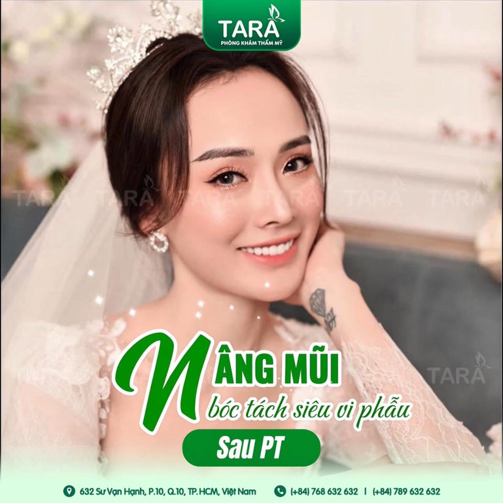 Nâng mũi siêu vi phẫu cấu trúc: Kiến tạo hoàn hảo dáng mũi
