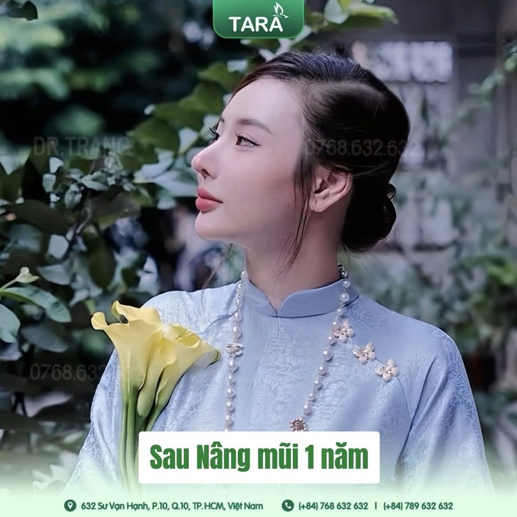 Nâng mũi siêu vi phẫu cấu trúc: Kiến tạo hoàn hảo dáng mũi