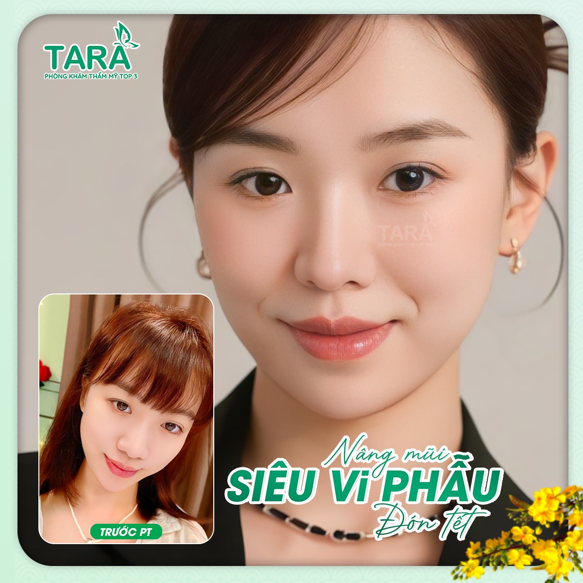 Nâng mũi ứng dụng đeo kính lúp siêu vi phẫu cho người bận rộn: 03 ngày vào form
