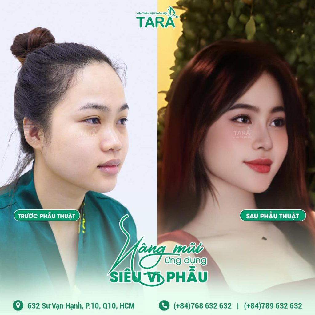 Nâng mũi siêu vi phẫu có ảnh hưởng gì đến sức khỏe không?