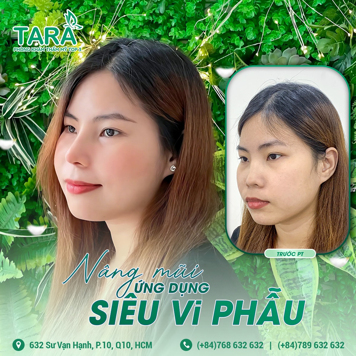 Nâng mũi ứng dụng đeo kính lúp siêu vi phẫu có vĩnh viễn không?