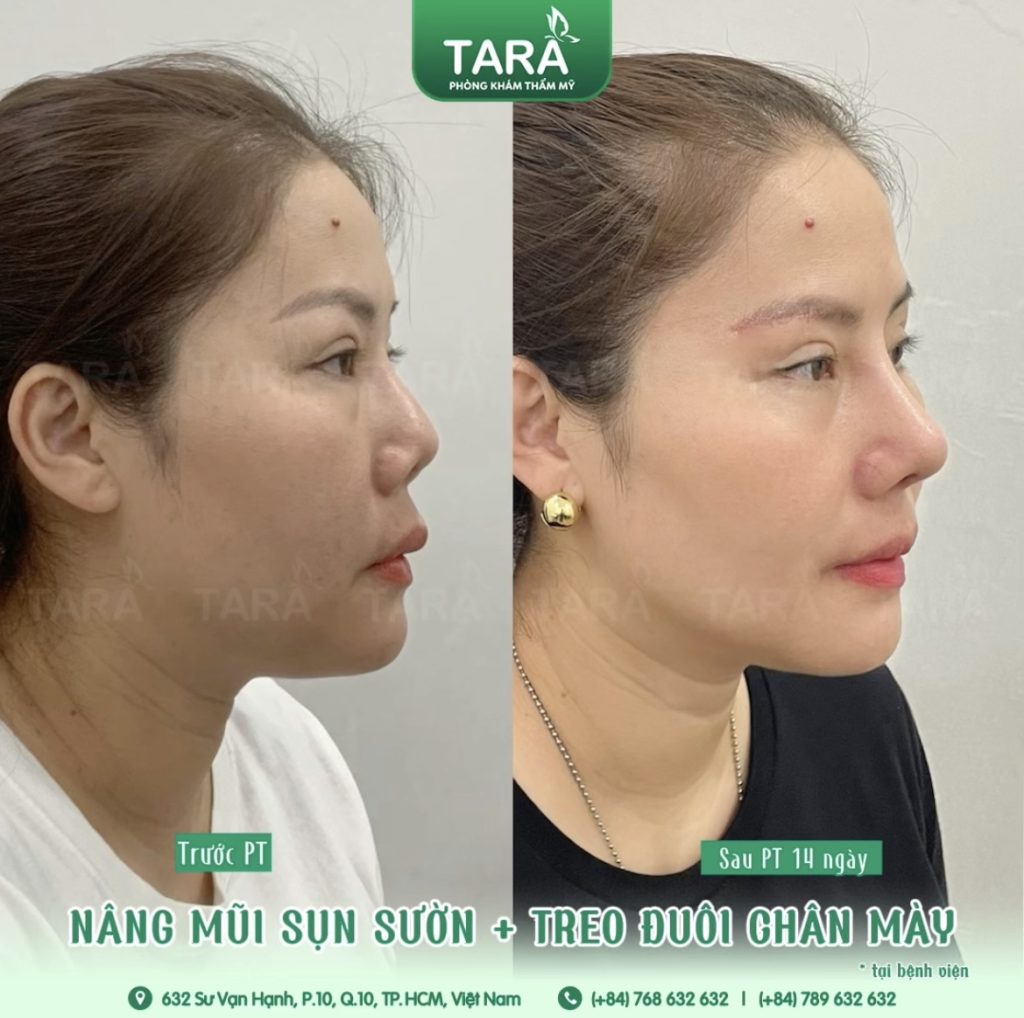 Nâng mũi siêu vi phẫu không nẹp cứng, 3 ngày vào form