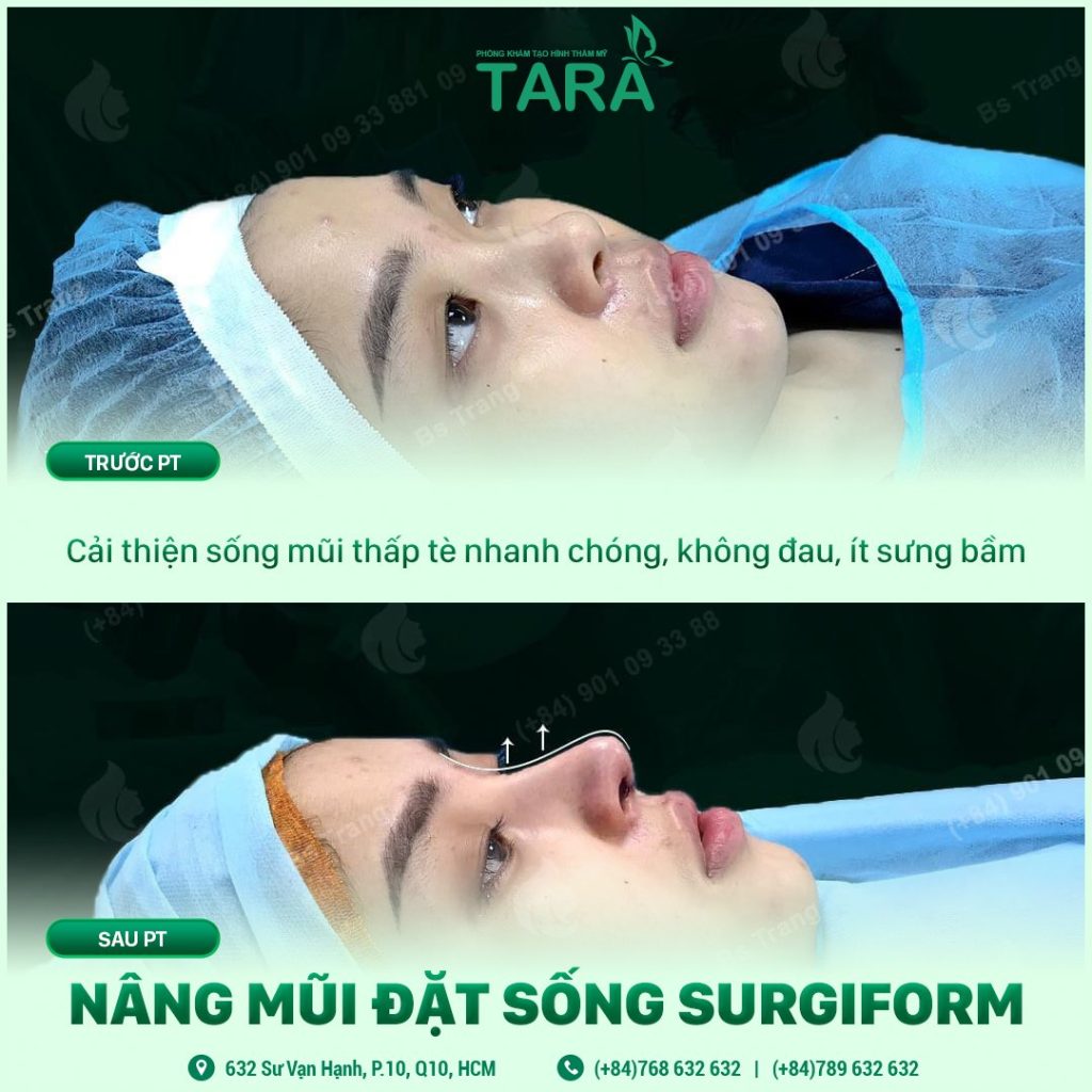 Nâng mũi siêu vi phẫu Surgiform: Kiến tạo dáng mũi tự nhiên hoàn hảo