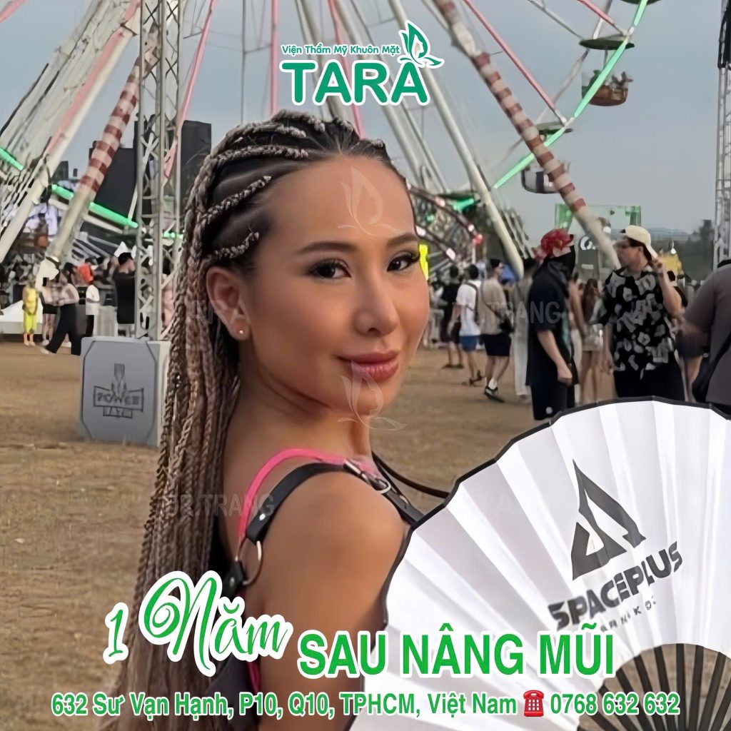 Nâng mũi siêu vi phẫu thu gọn mũi đầu to: Kiến tạo dáng mũi “tỷ lệ vàng”