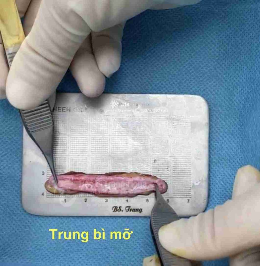 Nâng mũi siêu vi phẫu trung bì mỡ: Giải pháp cho mũi nhiễm trùng