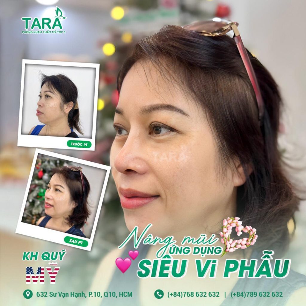 Nâng mũi siêu vi phẫu xong có được uống cafe không?