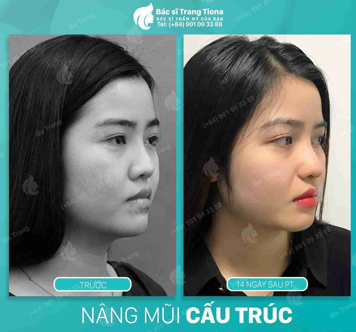 Giải đáp từ A-Z về nâng mũi Sline và lưu ý quan trọng