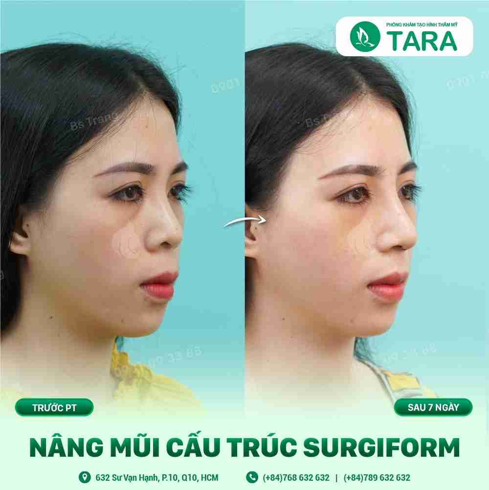 Nâng mũi sụn nhân tạo – Bí quyết sở hữu dáng mũi hoàn hảo