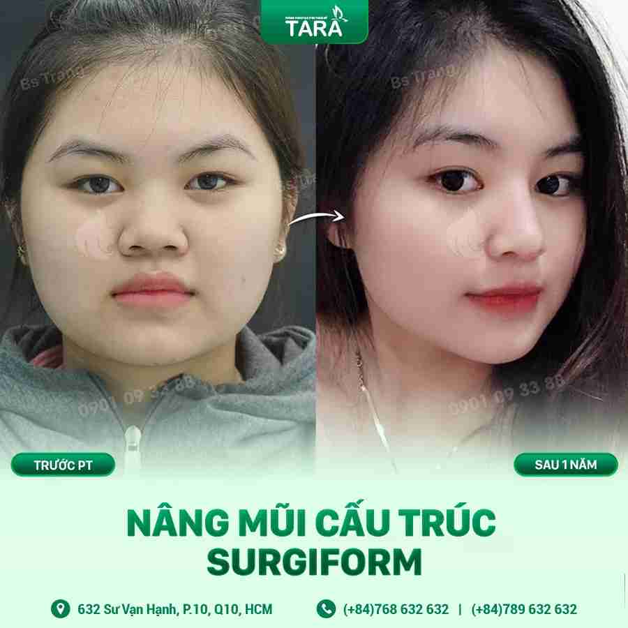 Giải đáp toàn bộ về nâng mũi sụn nhân tạo hiện nay