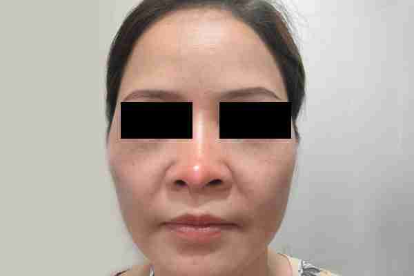 Giải đáp toàn bộ về nâng mũi sụn nhân tạo hiện nay