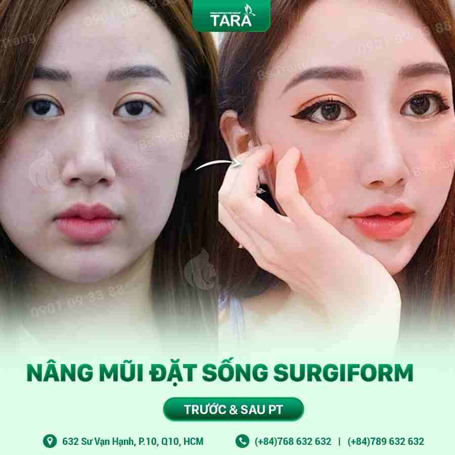 Giải đáp toàn bộ về nâng mũi sụn nhân tạo hiện nay