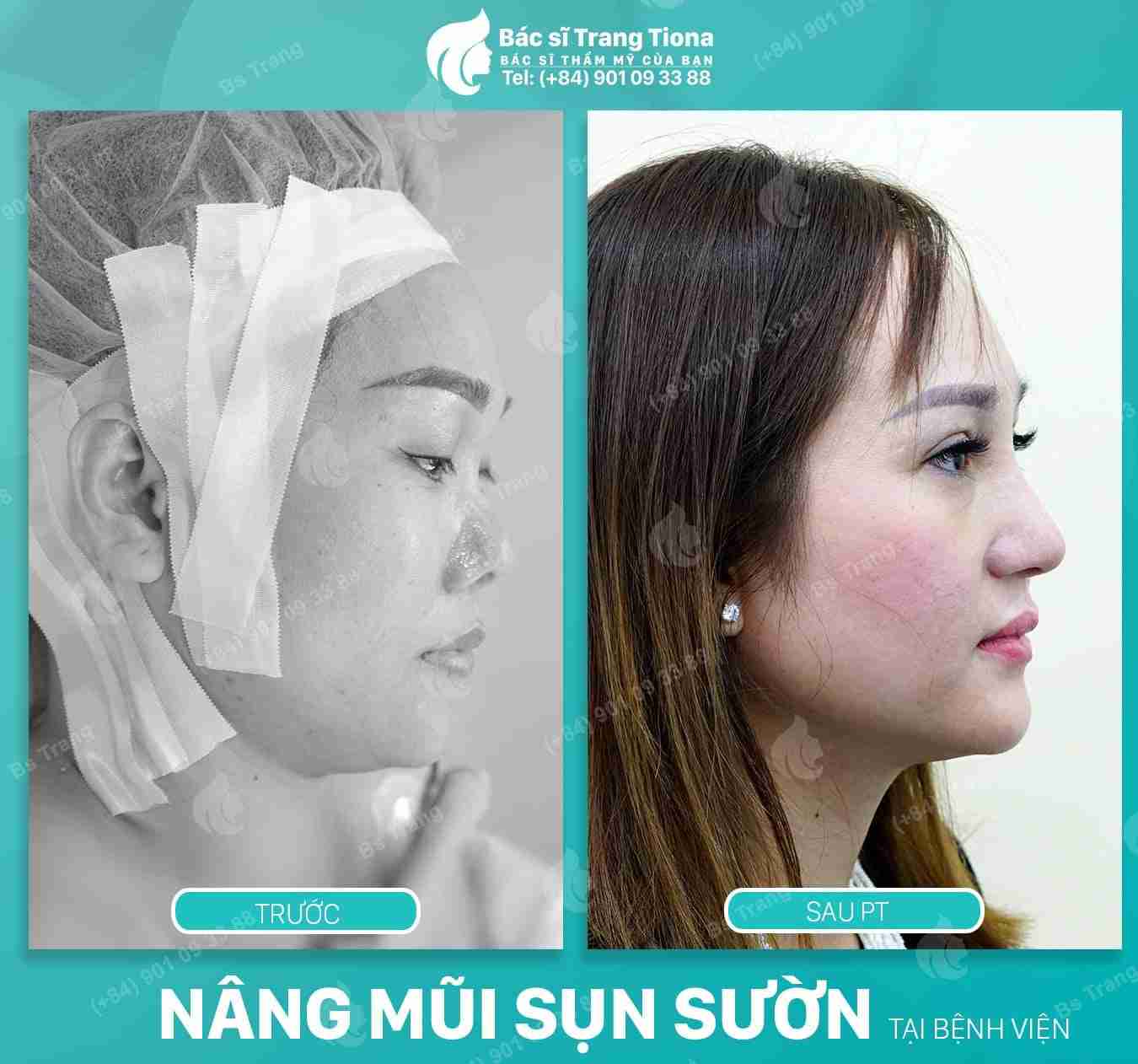 Nâng mũi sụn sườn bao lâu thì đẹp? Bao lâu vào form?