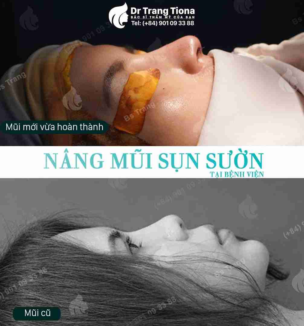 Nâng mũi sụn sườn bao lâu thì đẹp? Bao lâu vào form?