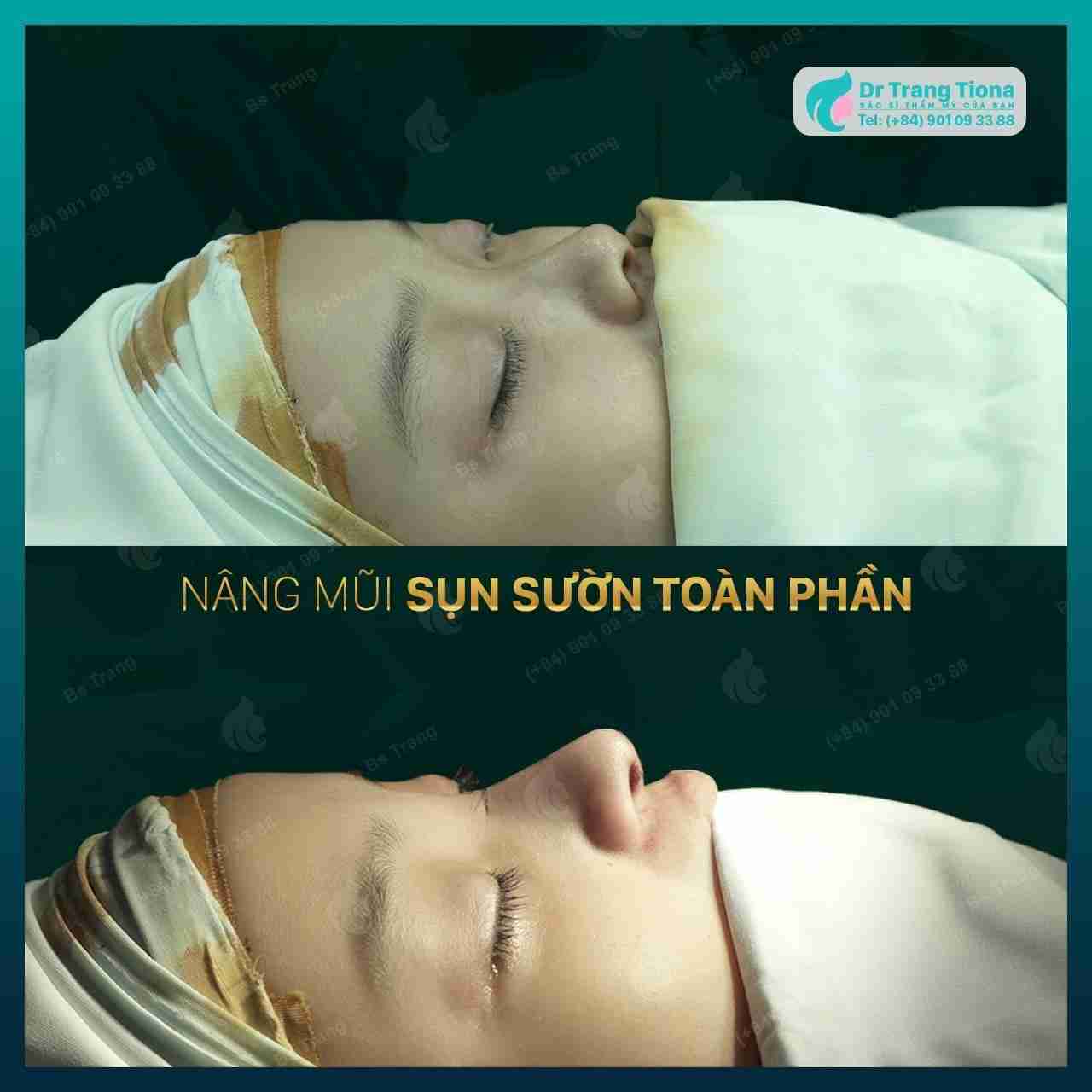 Bác sĩ giải đáp: Nâng mũi sụn sườn có bị teo lại không?