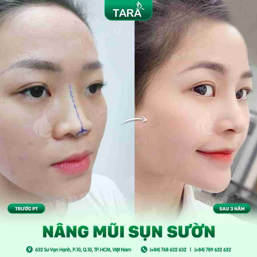 Nâng mũi sụn sườn – giải pháp vượt trội cho dáng mũi hoàn hảo
