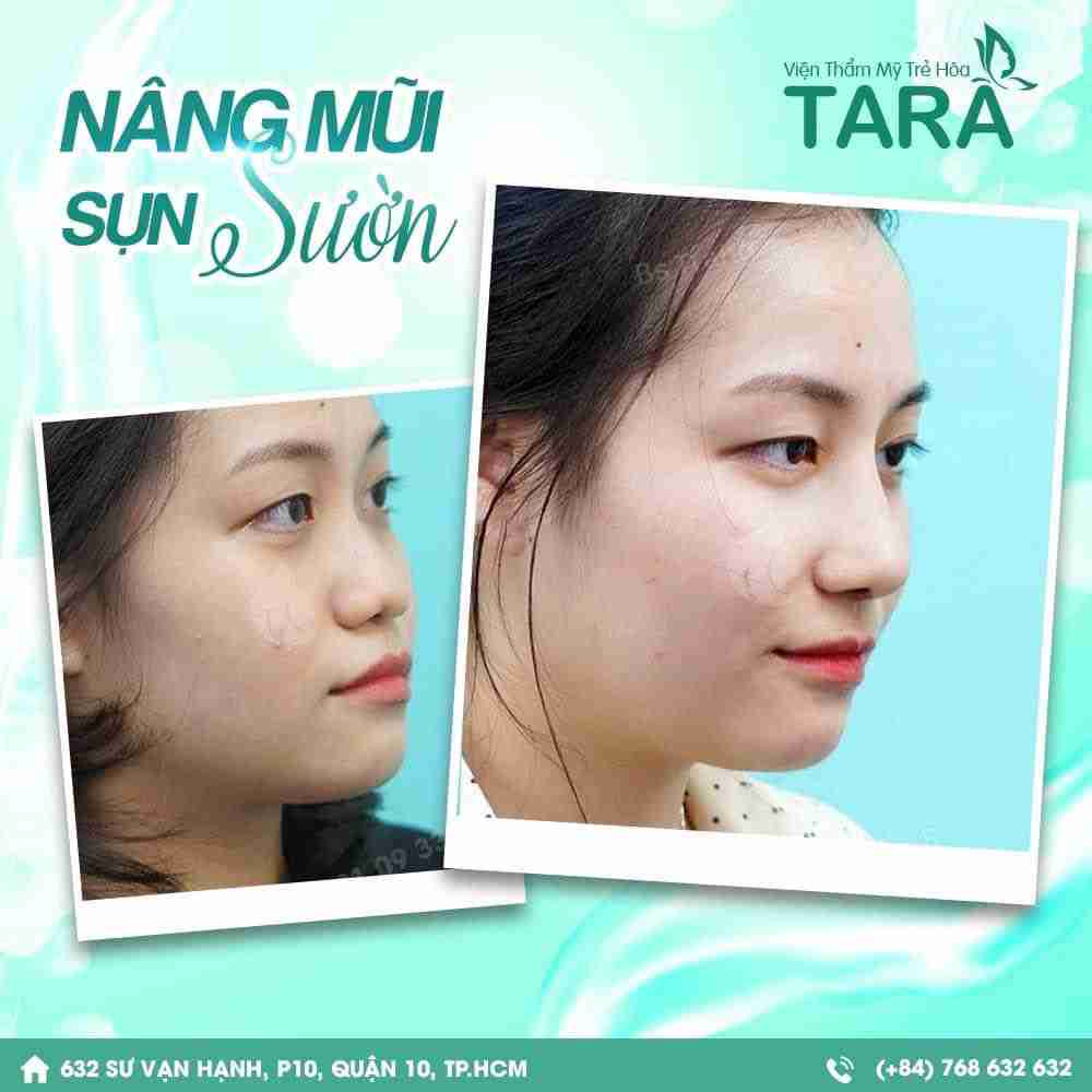 Nâng mũi sụn sườn giá bao nhiêu? Có đắt không?