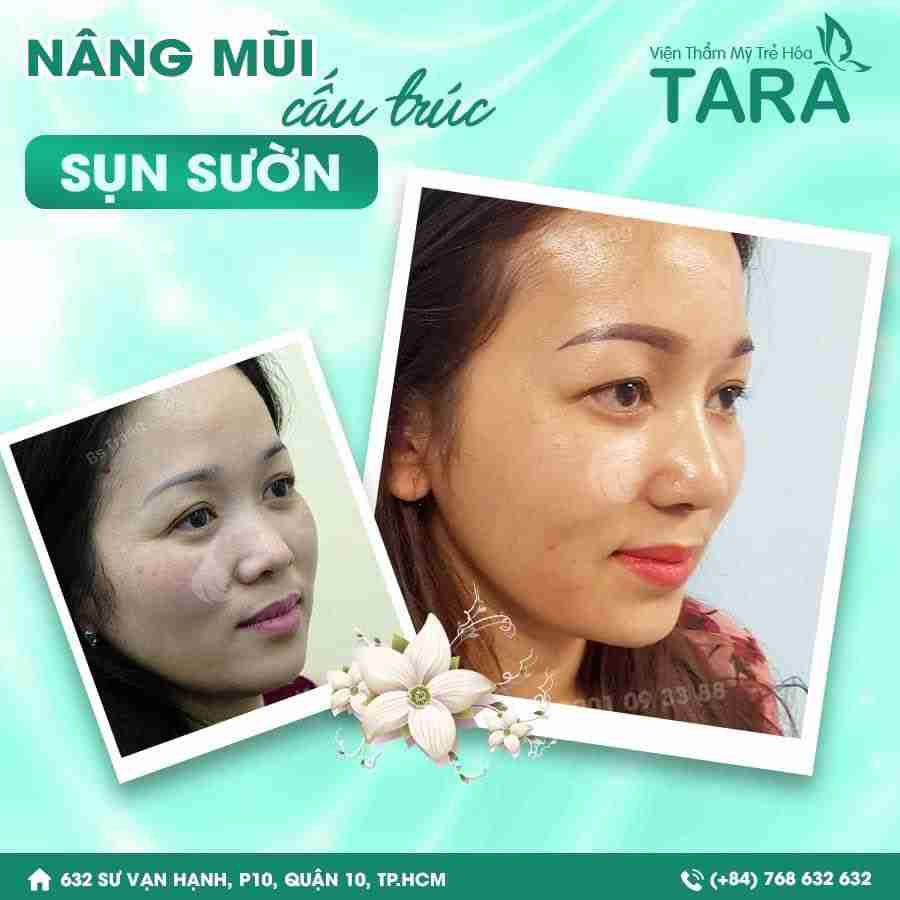 Nâng mũi sụn sườn giá bao nhiêu? Có đắt không?